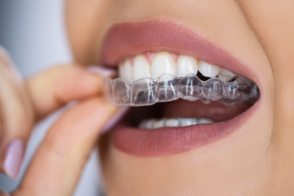Clear aligner tray being fitted over upper teeth