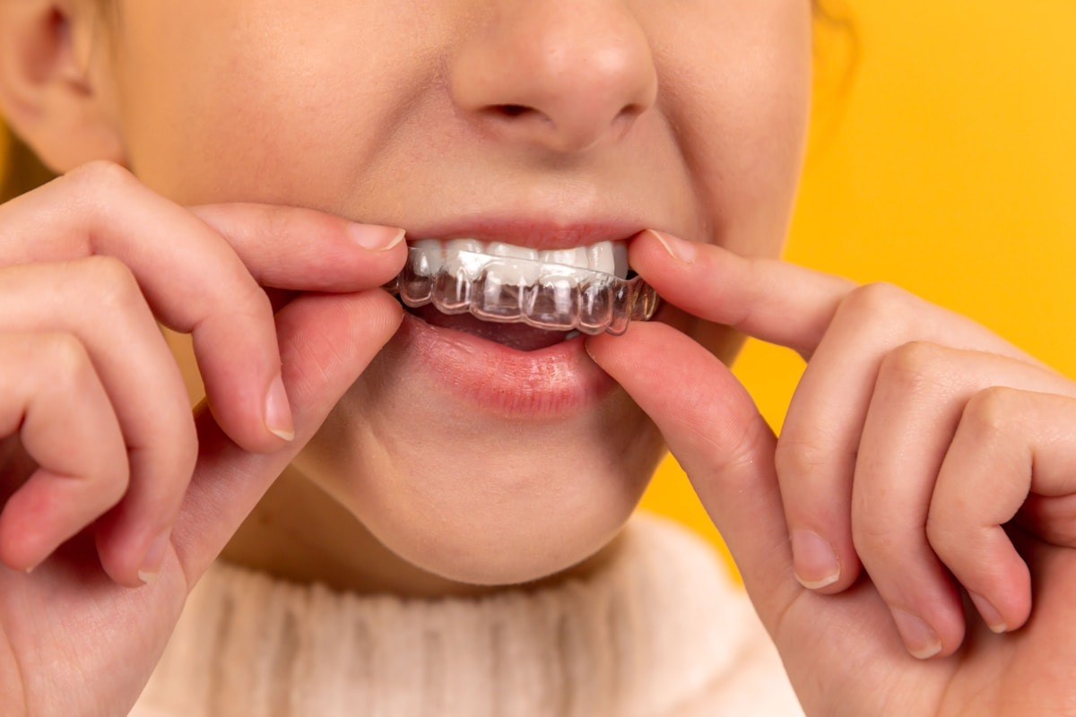 Clear aligner being placed over upper teeth at Supreme Elite Clinic