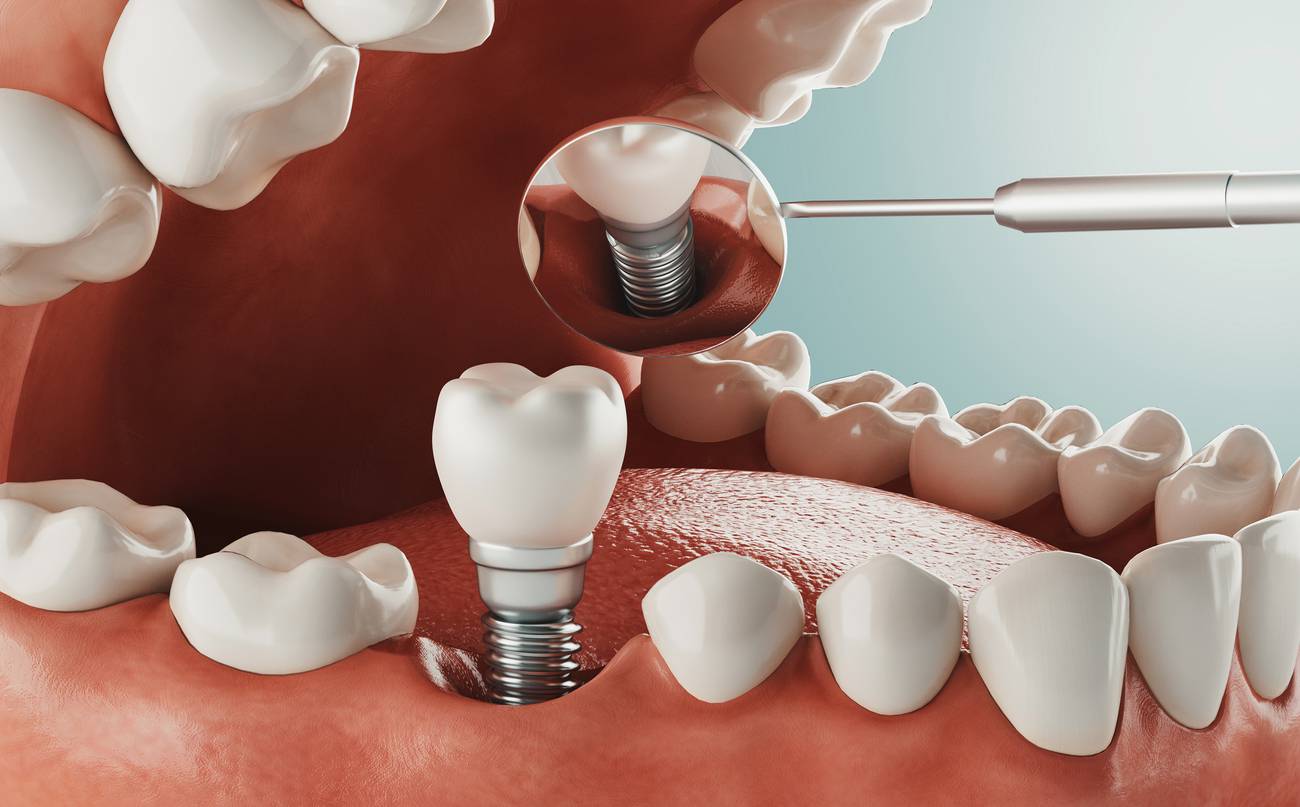 3D illustration of a dental implant screw, abutment and crown in the jaw